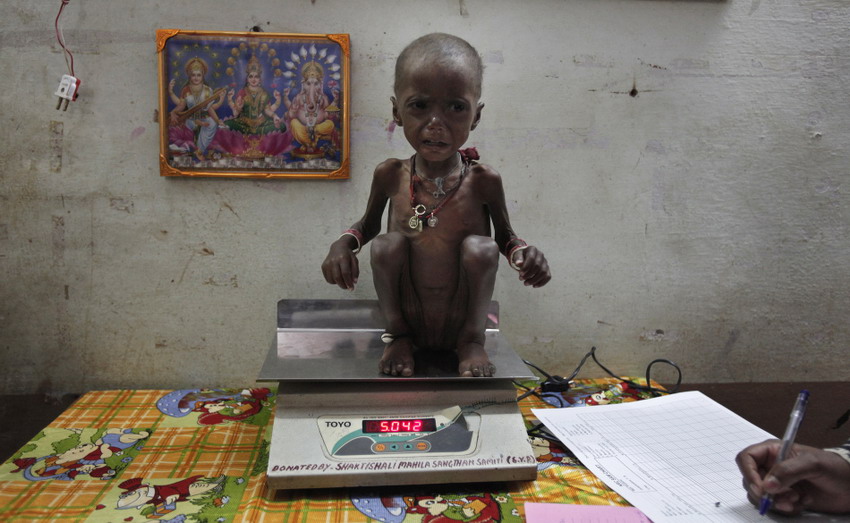 Severely malnourished two-year-old girl Rajini is weighted by a health worker in a nutritional recovery center in centra Shivpuri town, India on Feb 1, 2012. (Reuters/Adnan)