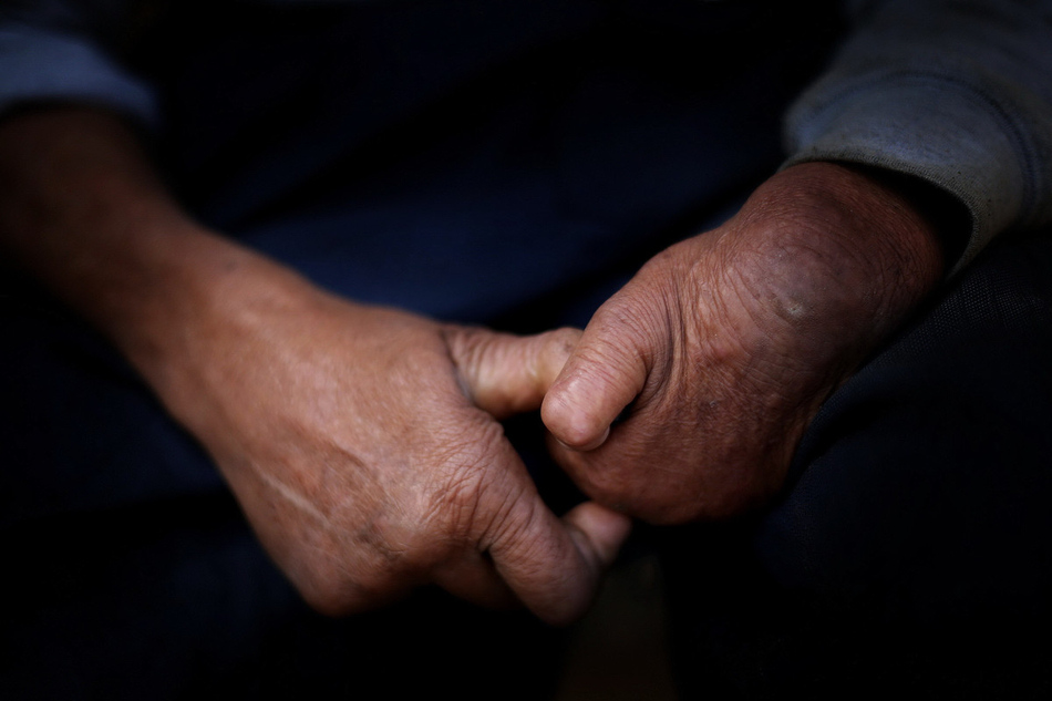 Yang Zike, 52, has suffered from leprosy for more than 30 years. His hands and feet have slowly improved.(Photo/Eastday)