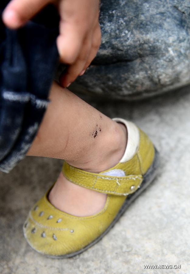 Four-year-old girl Du Xinrui shows a scar of a scratch during the earthquake on her ankle at a temporary settlement site in the quake-hit Lushan County, southwest China's Sichuan Province, April 22, 2013. (Xinhua/Zhang Hongxiang)