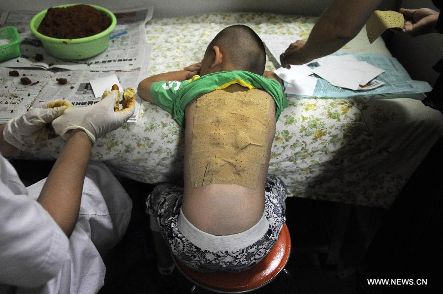 A doctor applies herb sticks to accupuncture points in hot summer days onto the back of a boy at the affiliated hospital of traditional Chinese medicine of Ningxia Medical University in Yinchuan, capital of northwest China's Ningxia Hui Autonomous Region, July 13, 2013. Saturday marks the beginning of the hottest part of summer. Many people go to their local hospitals of traditional Chinese medicine to apply herb sticks to accupuncture points to prevent diseases. (Xinhua/Li Ran)